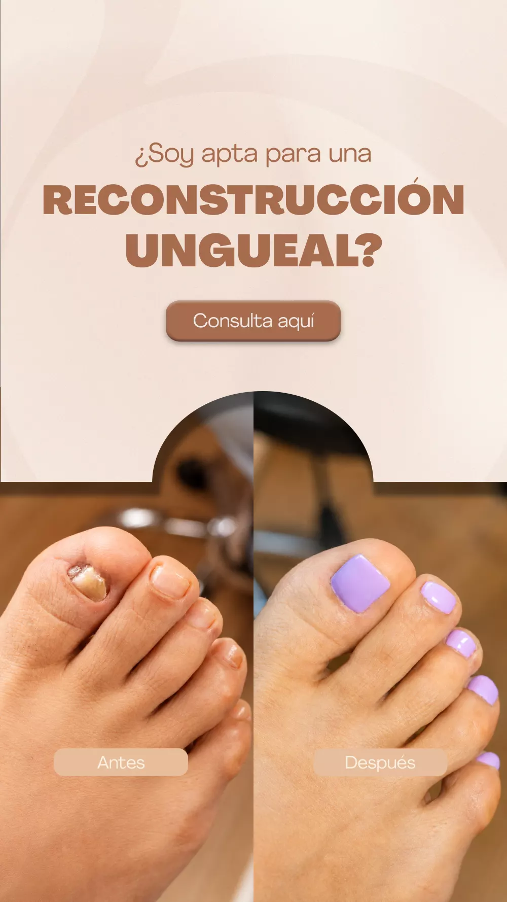 Reconstrucción ungueal - Podopedia Beauty