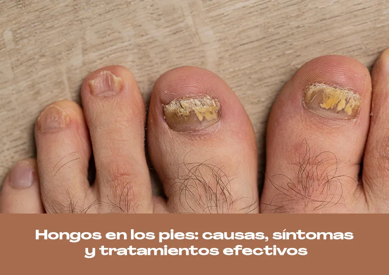Hongos en los pies: causas, síntomas y tratamientos efectivos