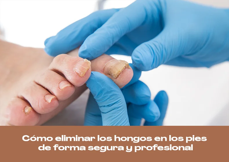 Cómo eliminar los hongos en los pies de forma segura y profesional