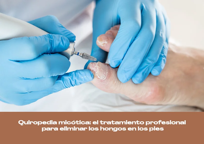 Quiropedia micótica: tratamiento para hongos en los pies