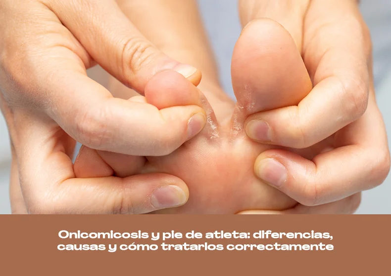 Onicomicosis y pie de atleta: diferencias, causas y cómo tratarlos