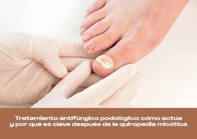 Tratamiento antifúngico: clave contra los hongos