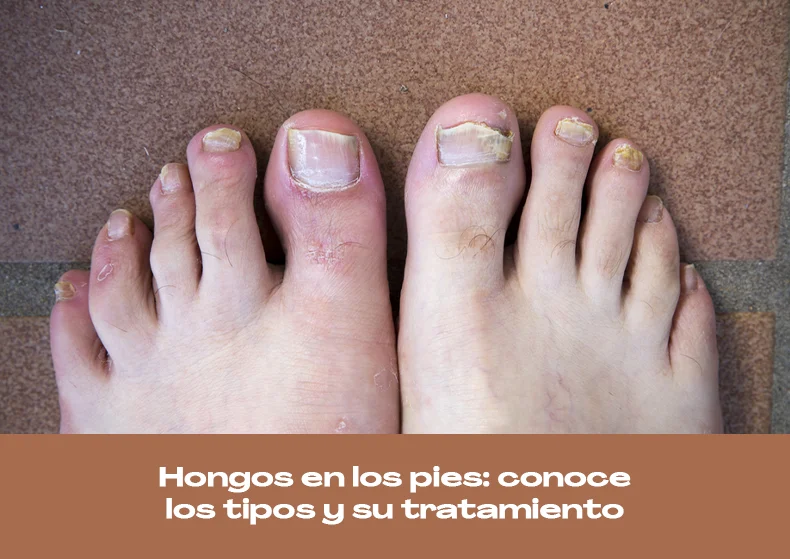 Hongos en los pies: conoce los tipos y su tratamiento