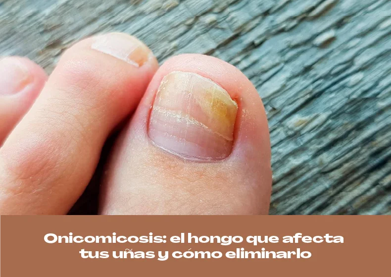 Onicomicosis: el hongo que afecta tus uñas y cómo eliminarlo