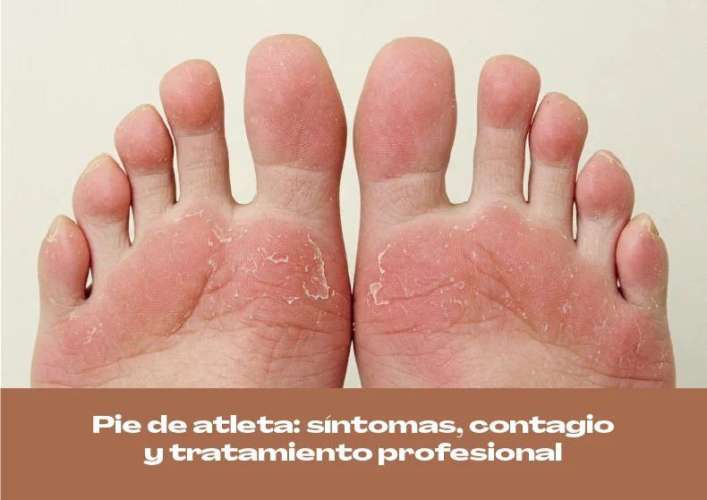 Pie de atleta: síntomas, contagio y tratamiento profesional