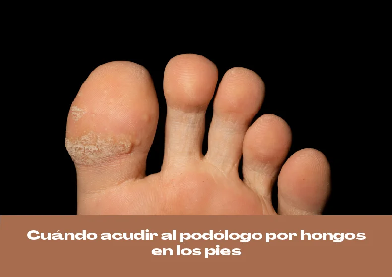 Cuándo acudir al podólogo por hongos en los pies