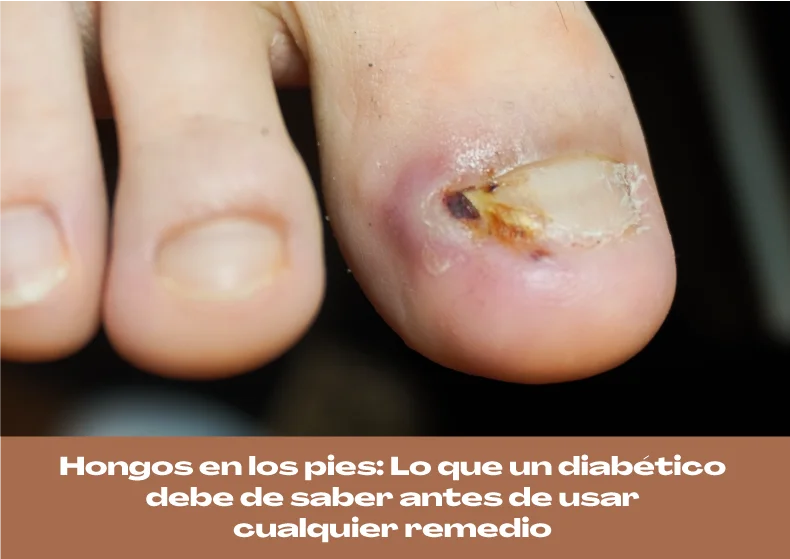 Hongos en los pies y diabetes: Lo que debes saber antes de usar remedios caseros