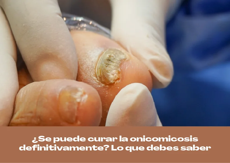 ¿Se puede curar la onicomicosis definitivamente?