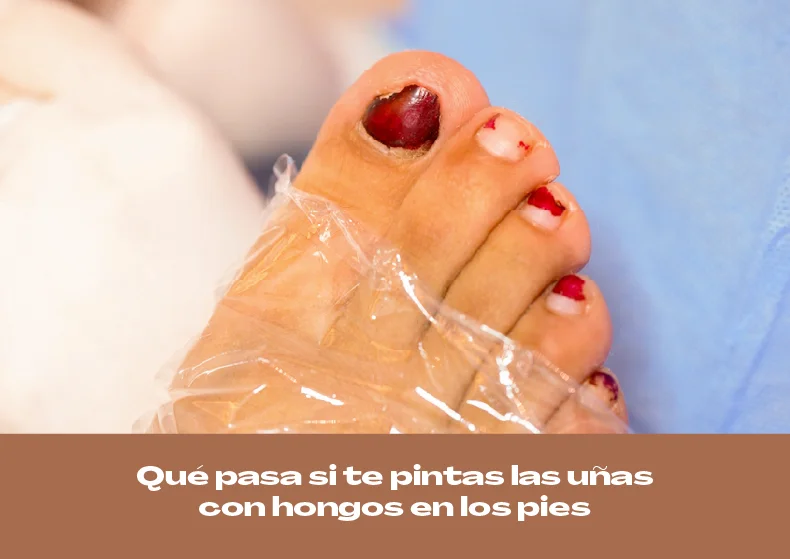 ¿Qué pasa si te pintas las uñas con hongos en los pies?