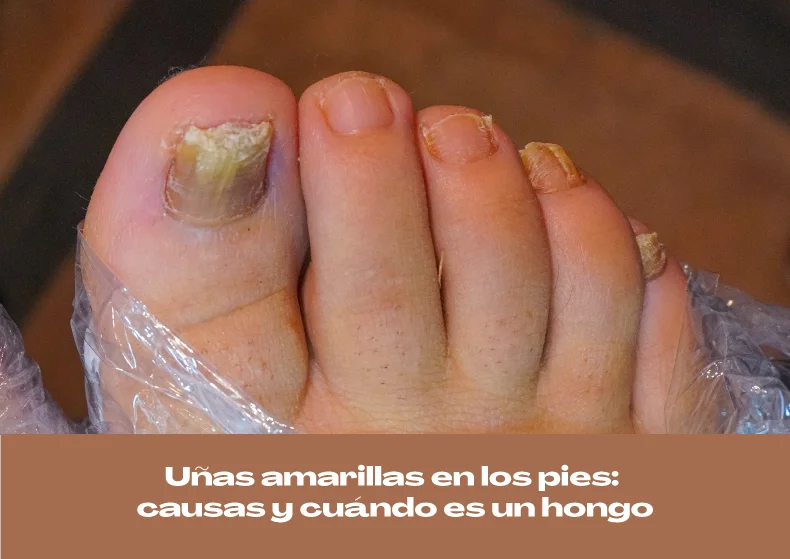 Uñas amarillas en los pies: causas y cuándo es un hongo