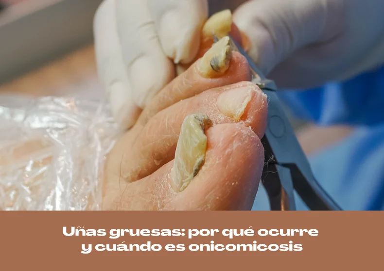 Uñas gruesas: por qué ocurre y cuándo es onicomicosis