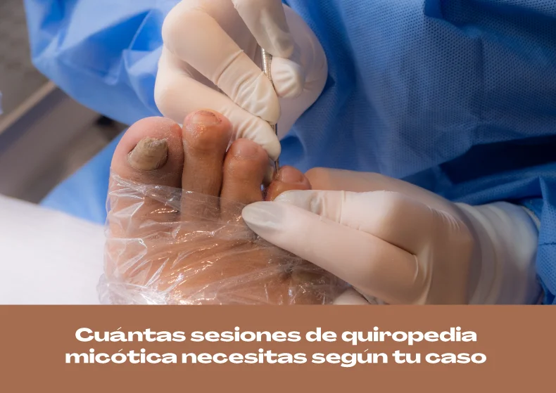 Cuántas sesiones de quiropedia micótica necesitas según tu caso