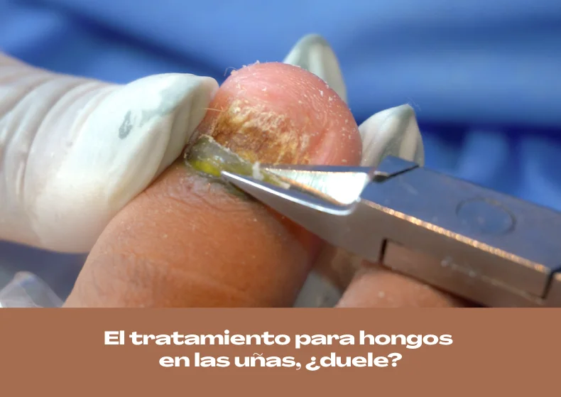 ¿El tratamiento para hongos en las uñas duele?