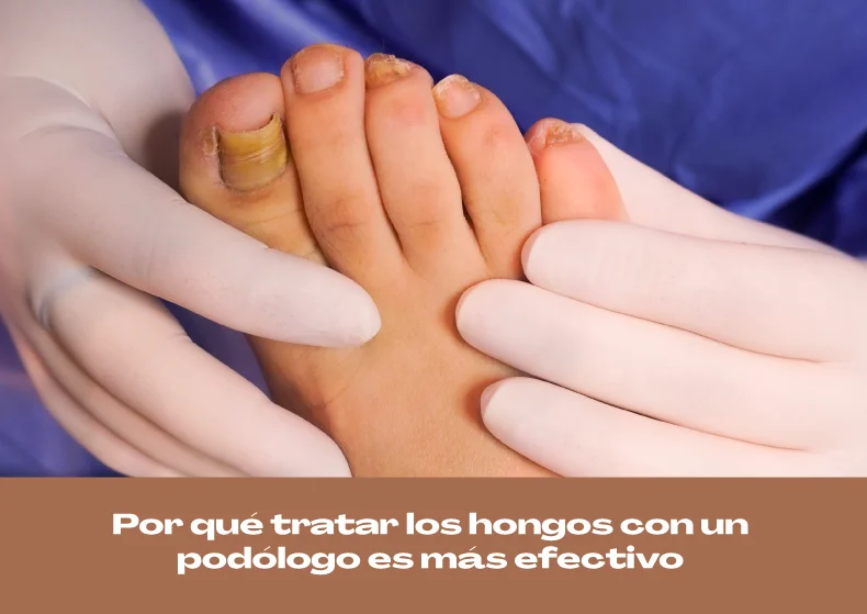 Por qué tratar los hongos con un podólogo es más efectivo