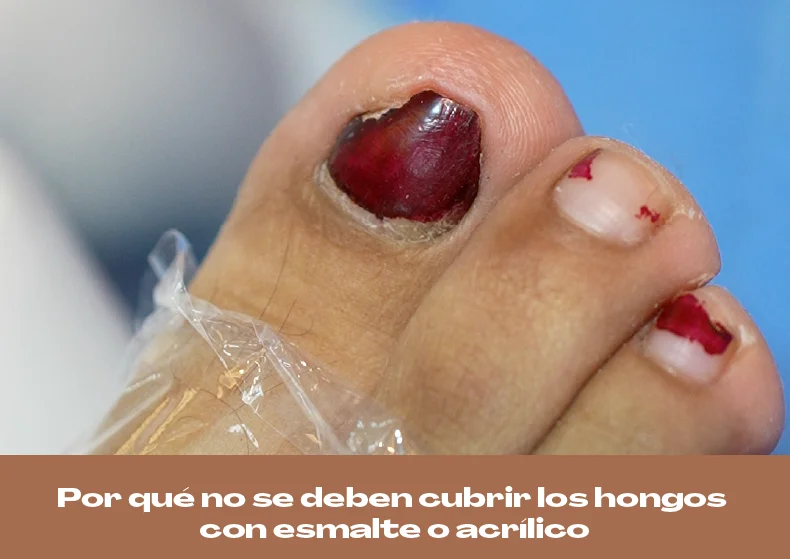 Por qué no cubrir hongos con esmalte o acrílico