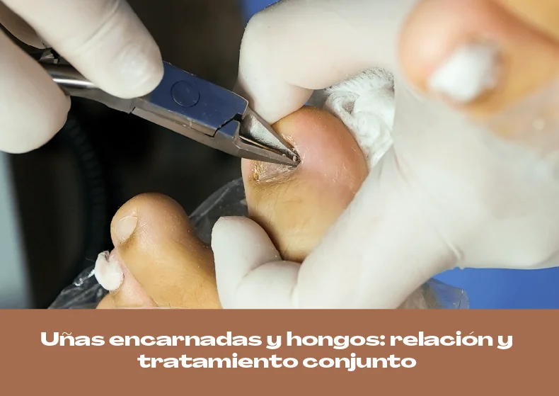 Uñas encarnadas y hongos: relación y tratamiento conjunto