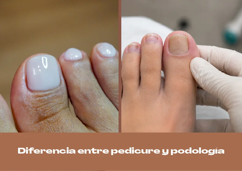 Podólogo o dermatólogo: ¿quién trata los hongos de los pies?