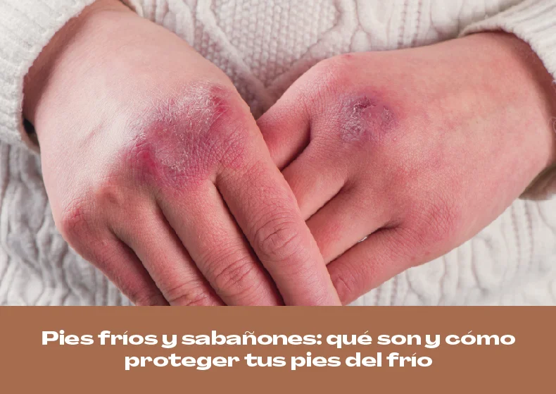 Pies fríos y sabañones en invierno