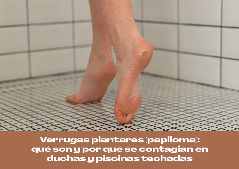 Verrugas plantares o papiloma en la planta del pie