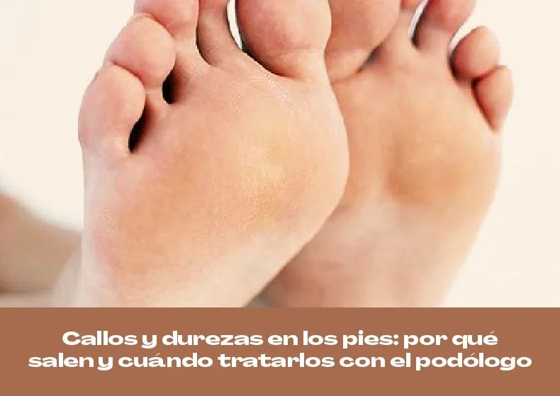 Callos y durezas en los pies