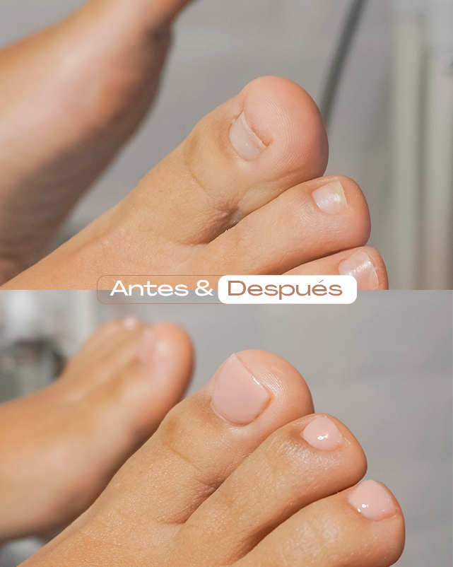 Reconstruccion-ungueal